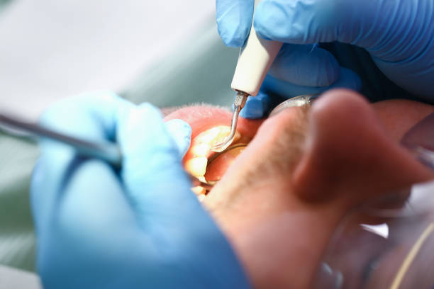 Emergency Treatment for Knocked-Out Teeth